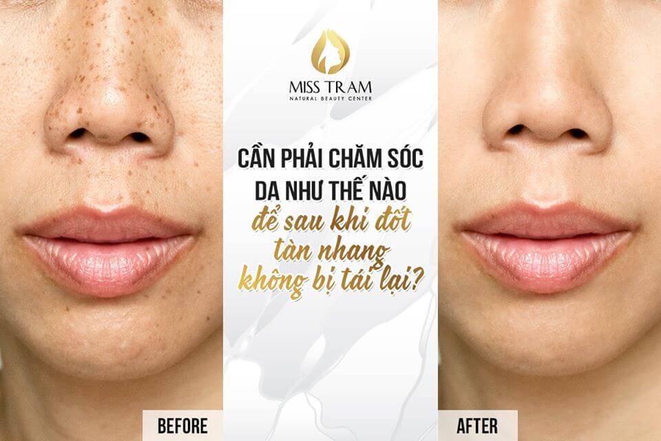 Sau Khi Đốt Tàn Nhang, Cần Lưu Ý Chăm Sóc Da Như Thế Nào 3