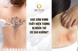 After Tattoo Removal, You Can See The Itching Phenomenon So Why Not 58