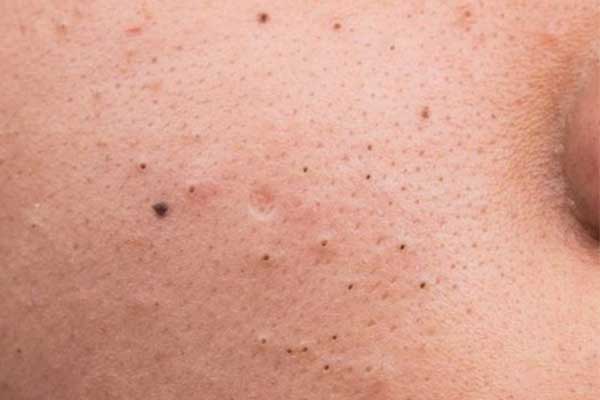 Learn the Stages of Acne 8