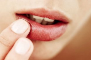 Why Is There Phenomenon Of Fussing And Blistering When Spraying Lips 7