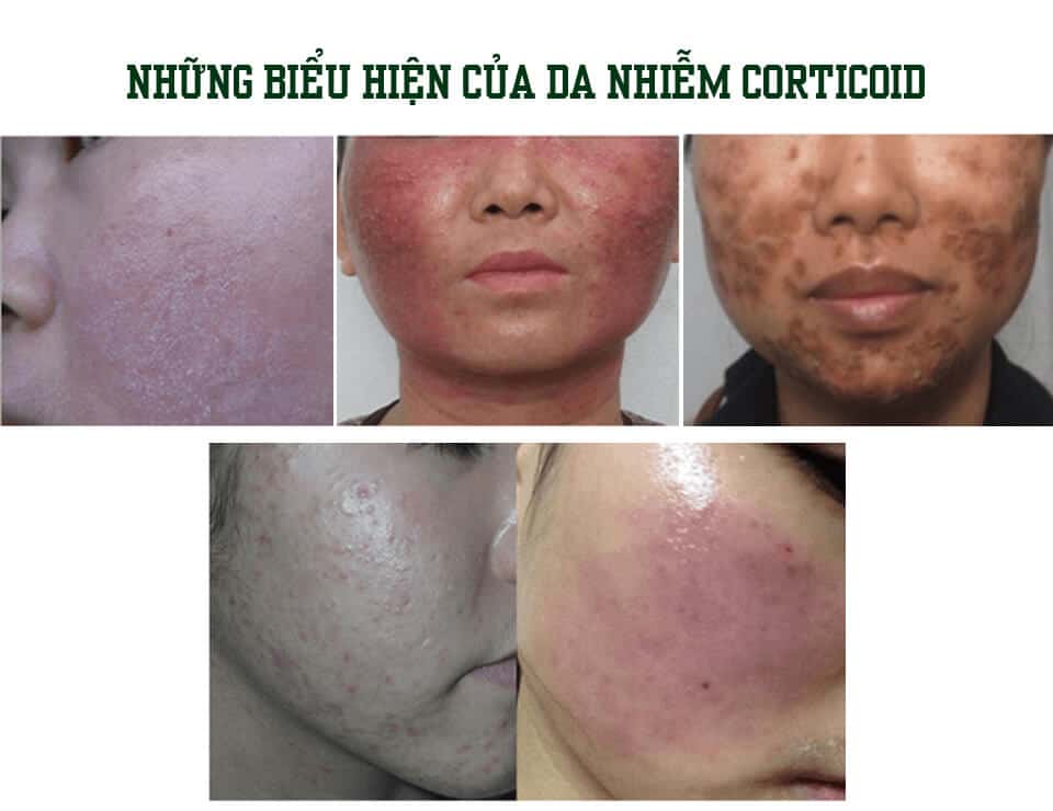 Da bị nhiễm Corticoid là gì? Cách xử lý hiệu quả 1