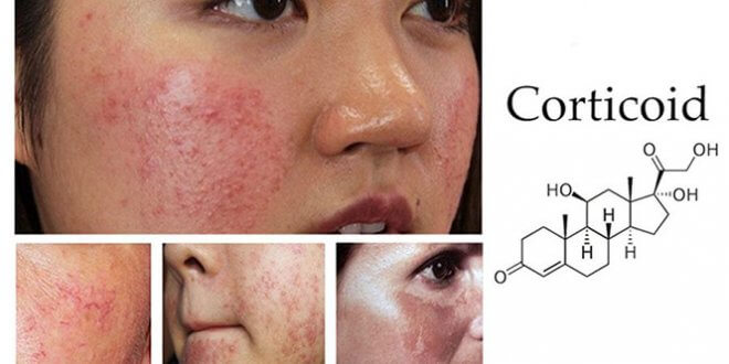 Identifying Corticoid Contaminated Skin And How To Treat It 3