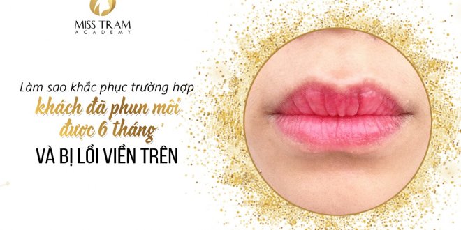 How To Fix The Case Of A Customer Who Has Been Spraying Lips For 6 Months And Has Protruding Upper Border