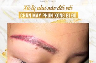 Xử Lý Như Nào Đối Với Chân Mày Phun Xong Bị Đỏ