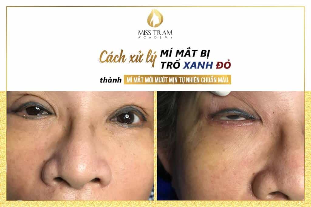 Xử Lý Mí Mắt Trổ Xanh, Đỏ Thành Mí Mắt Mới Mướt Mịn Tự Nhiên 3