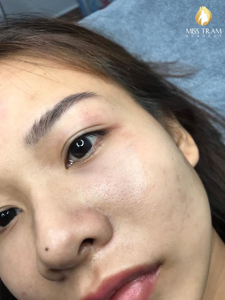 Photo on Eyelid Spray Sample - No Swelling, No Pain 13