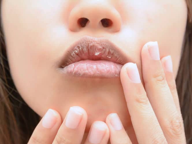 how to treat dry spray lips