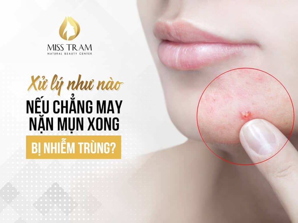 Xử Lý Như Nào Nếu Chẳng May Nặn Mụn Xong Bị Nhiễm Trùng 3