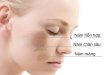 All about Melasma: Causes, Symptoms, Diagnosis and Treatment Direction 32