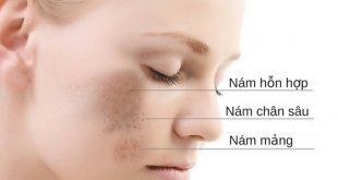 All about Melasma: Causes, Symptoms, Diagnosis and Treatment Direction 3