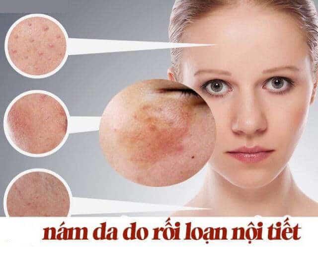 Nám nội tiết là gì? Cách phân biệt nám da nội tiết 3