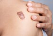 What Is Keloid Scar? Causes of Formation & Effective Treatment of Keloid Scars 8