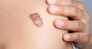 What Is Keloid Scar? Causes of Formation & Effective Treatment of Keloid Scars 1
