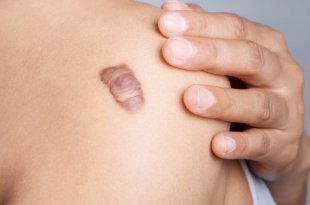 What Is Keloid Scar? Causes of Formation & Effective Treatment of Keloid Scars 48
