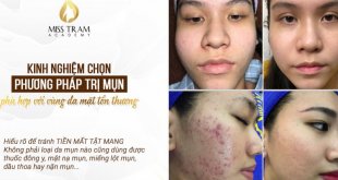 How to Treat Acne Grades: Mild and Severe 7