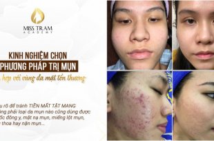 How to Treat Acne Grades: Mild and Severe 8