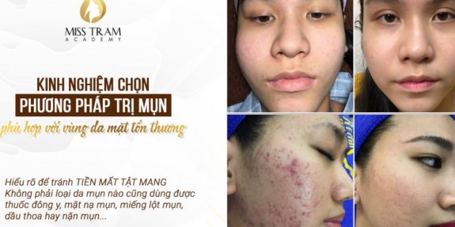 How to Treat Acne Grades: Mild and Severe 2