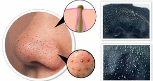 Identify Common Types of Small Acne & Treatment 2