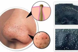 Identify Common Types of Small Acne & Treatment 25
