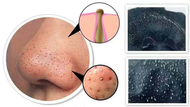 Causes of tiny acne