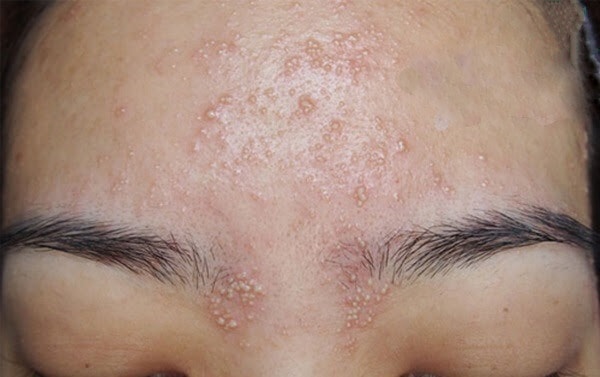 Identify Common Types of Small Acne And How To Treat It 11
