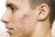 How To Treat Inflammatory Acne Without Scars In Men 54