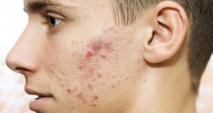 How To Treat Inflammatory Acne Without Scars In Men 1