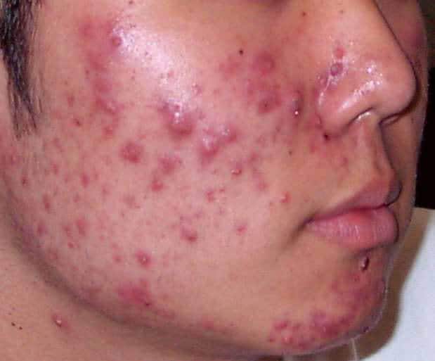 What causes inflammatory acne?