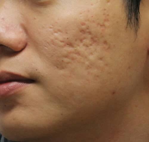 how to treat inflammatory acne for men