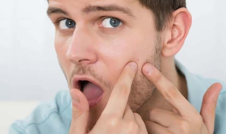 safe inflammatory acne tips for men
