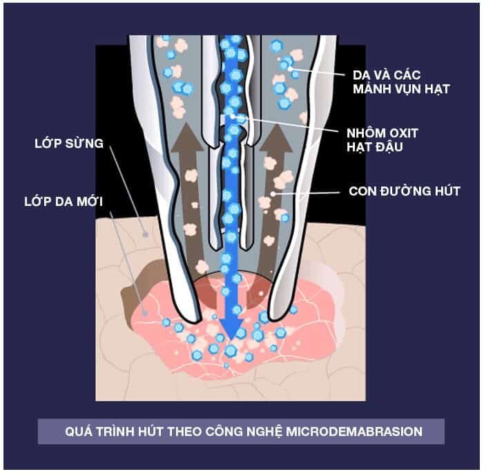 công nghệ tẩy da chết Microdermabrasion