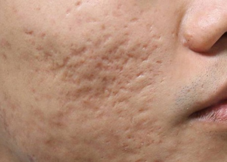 What are acne scars?