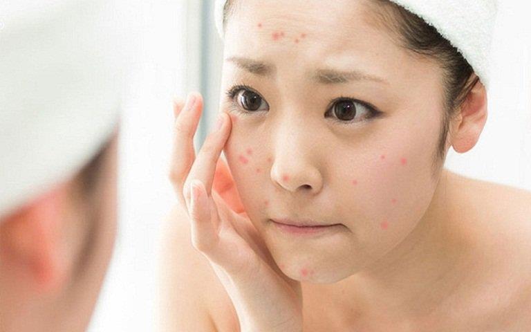 The microbiological system on the skin affects the acne-causing process
