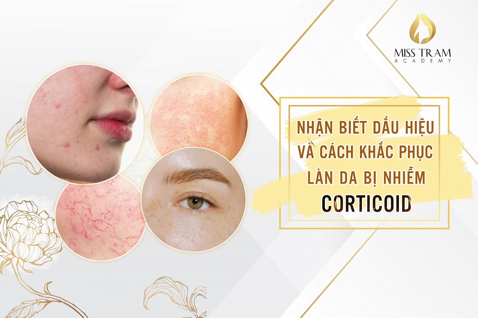 Khóa Học: Chăm Sóc & Điều Trị Da Nhiễm Corticoid