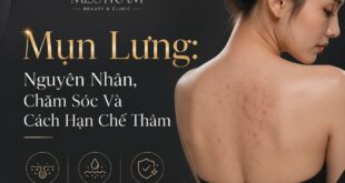 Mụn Lưng: Nguyên Nhân, Chăm Sóc Và Cách Hạn Chế Thâm 1